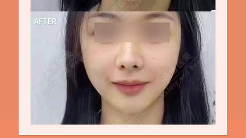 玻尿酸肉毒素注射后，如何正确护理？**