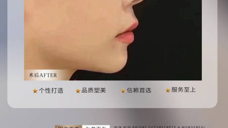 成都激光祛斑哪家正规