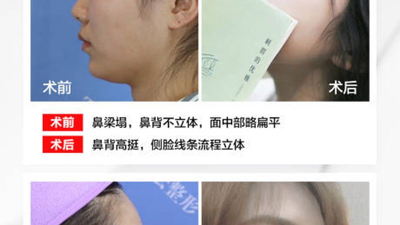成都光子嫩肤院线仪器定制，揭秘其背后的技术奥秘