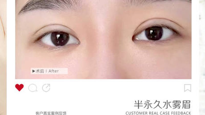 玻尿酸注射，成都地区价格揭秘与选择指南